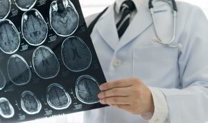 Makin banyak warga Indonesia alami stroke di usia muda, ini penyebabnya