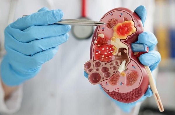 Ilustrasi penyebab gagal ginjal akut dan cara mencegahnya 1 169